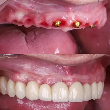 Antes y después rehabilitación oral completa sobre implantes