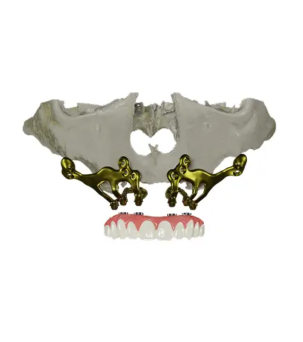implantes subperiosticos dentales