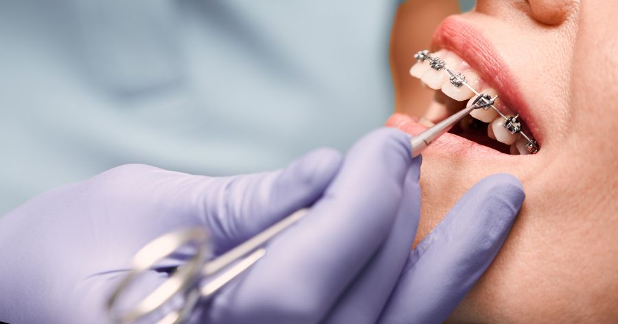 tratamiento brackets ortodoncia madrid