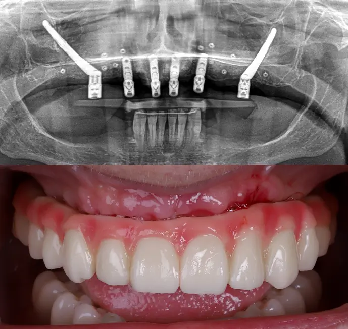 implantes cigomaticos resultado