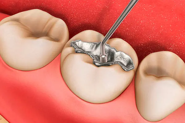 amalgama dental empaste