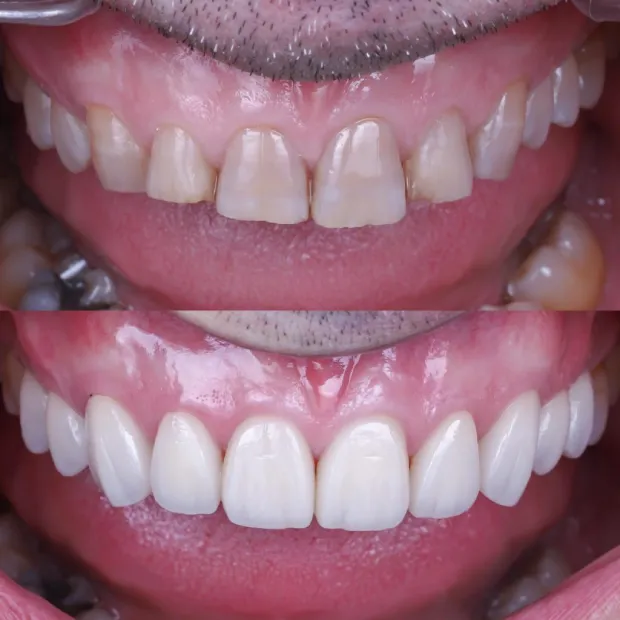 resultado implantes dentales antes despues