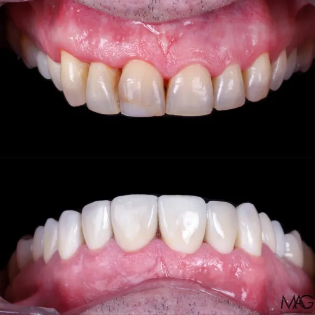 antes despues implantes fijos