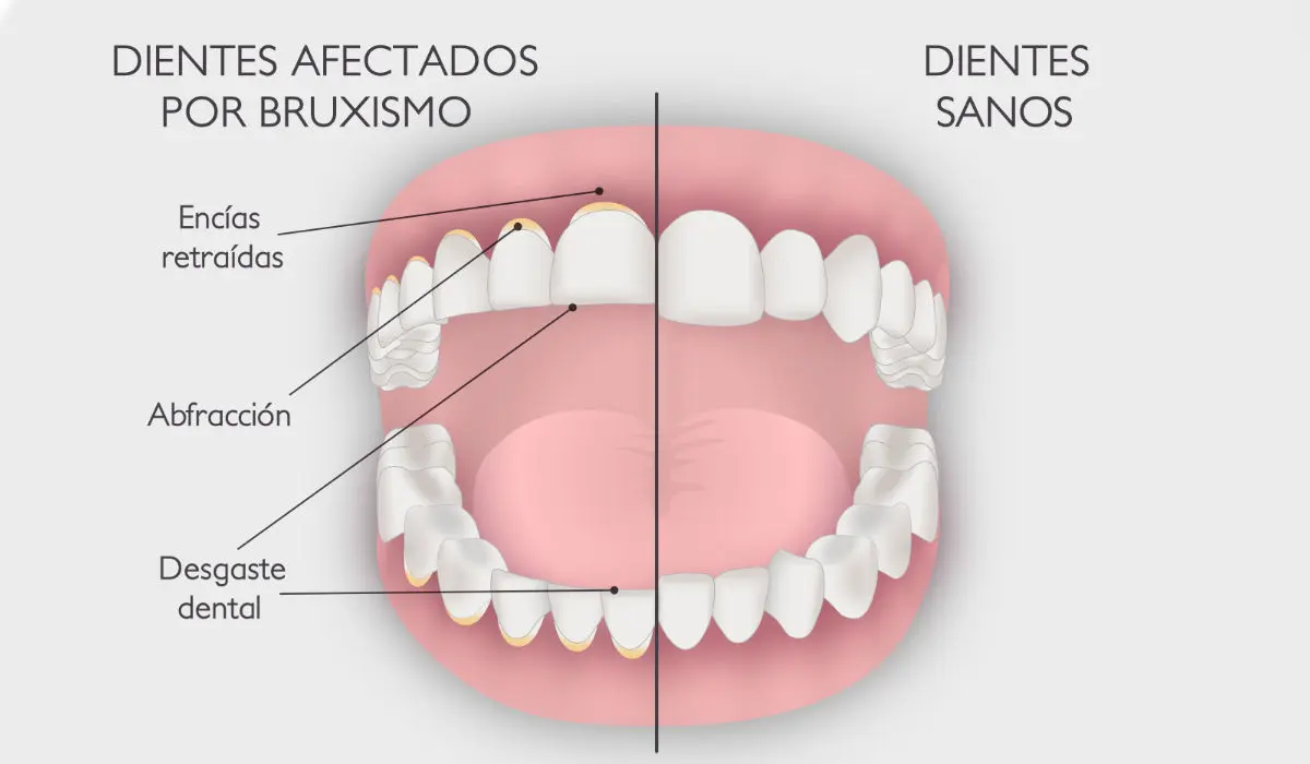 tratamiento bruxismo ferula