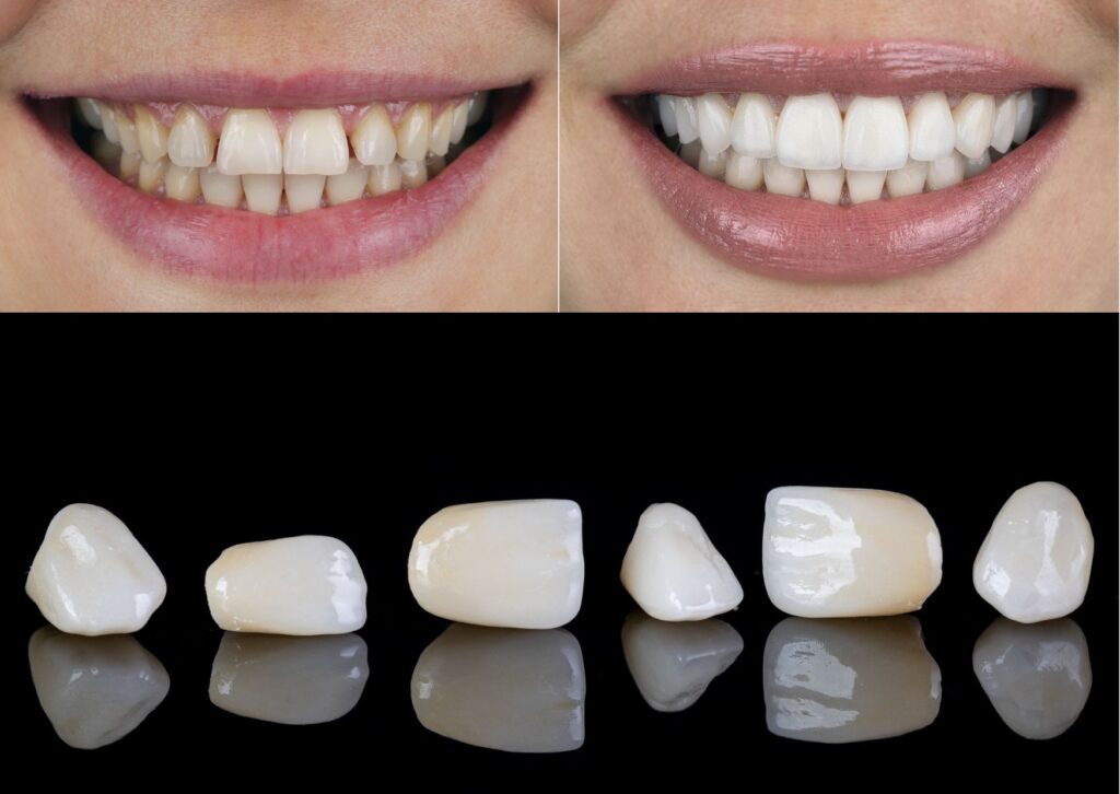 coronas de zirconio dentales