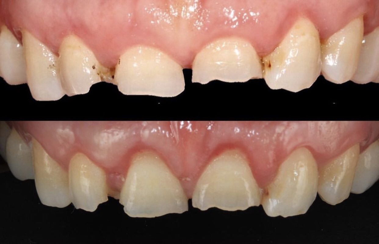 desgaste dental por bruxismo
