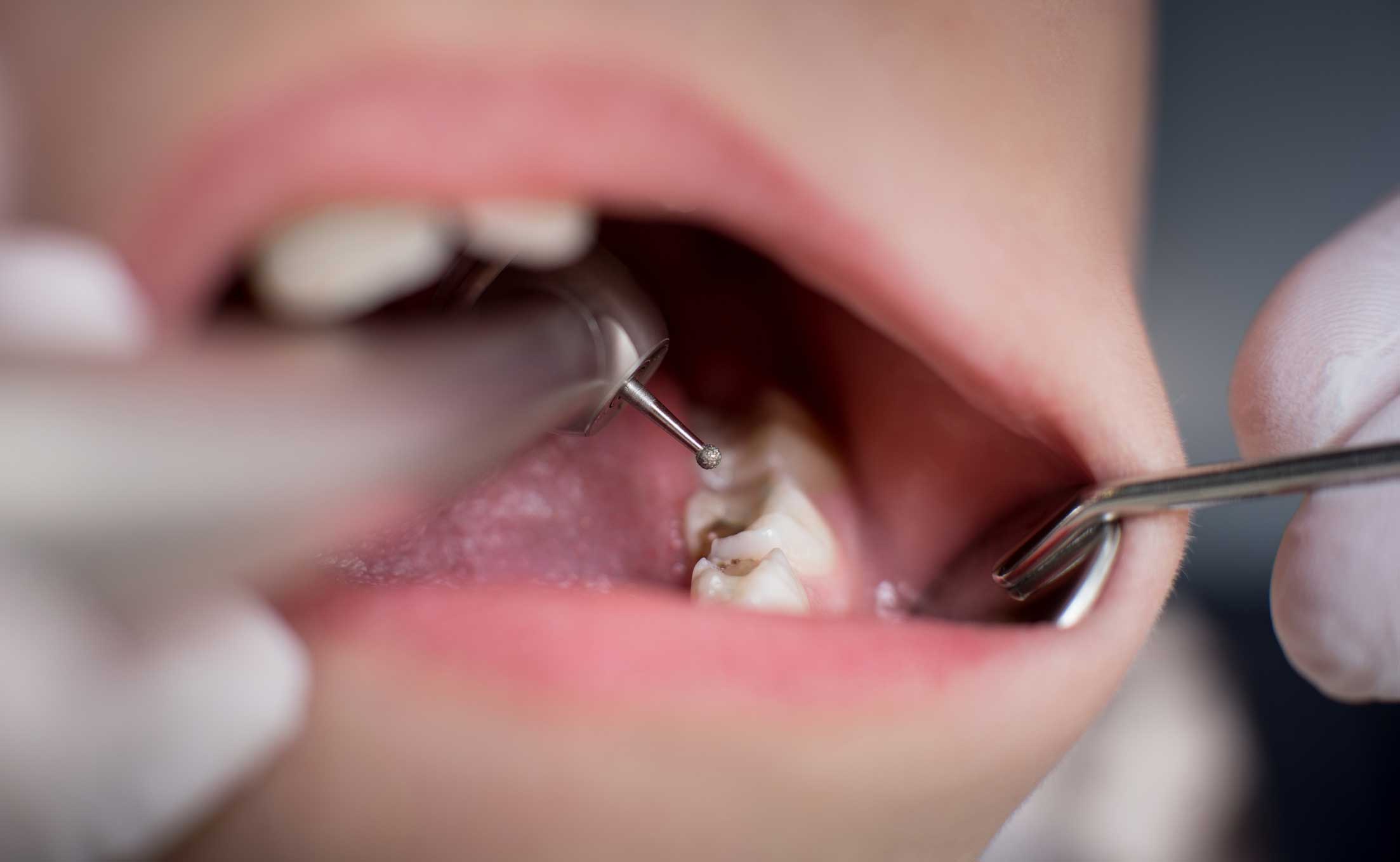 empaste dental niños caries