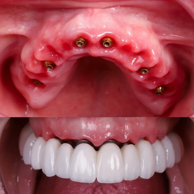implantes carga inmediata proceso