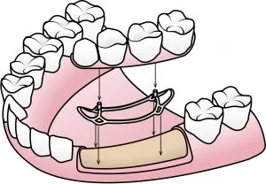 implantes dentales sin tornillos