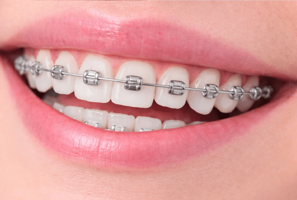 brackets ortodoncia dental