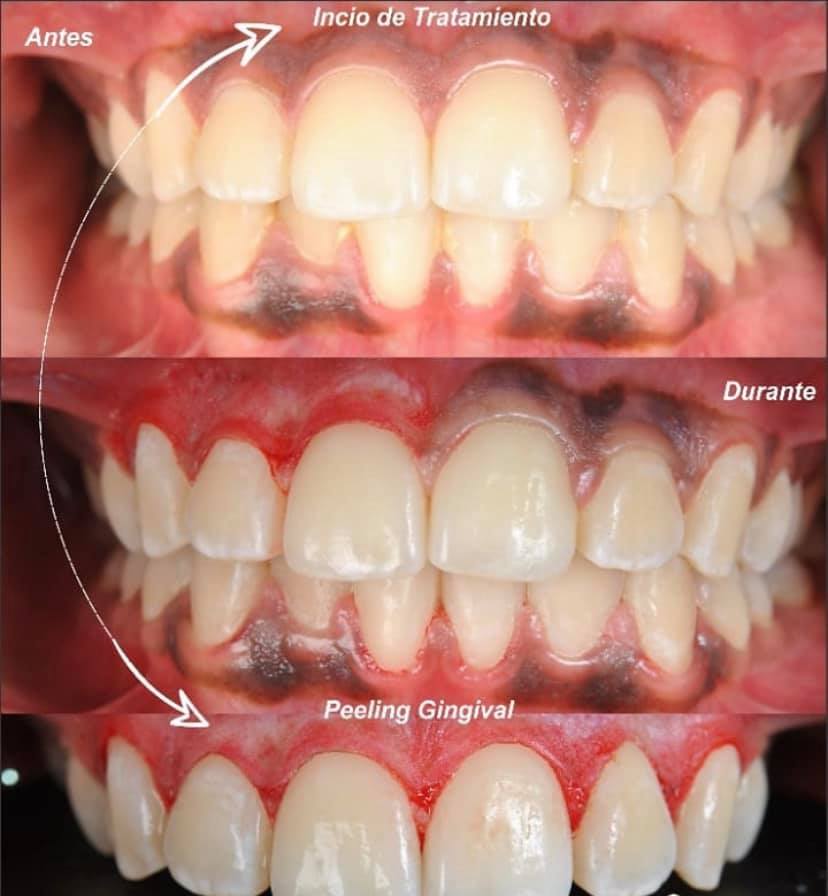 procedimiento peeling gingival