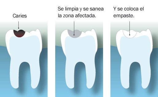 proceso empaste dental