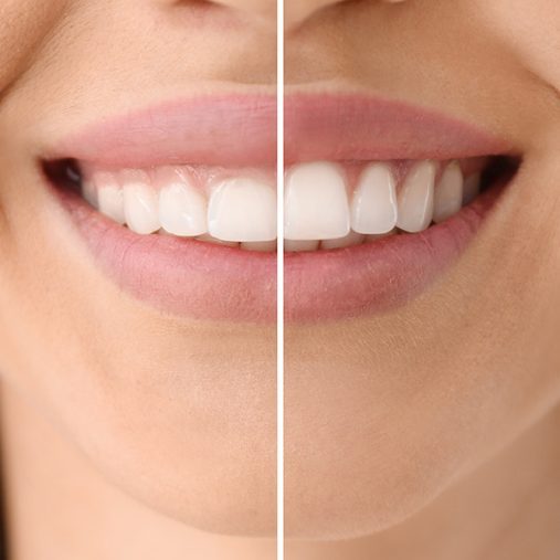 sonrisa gingival exceso encia