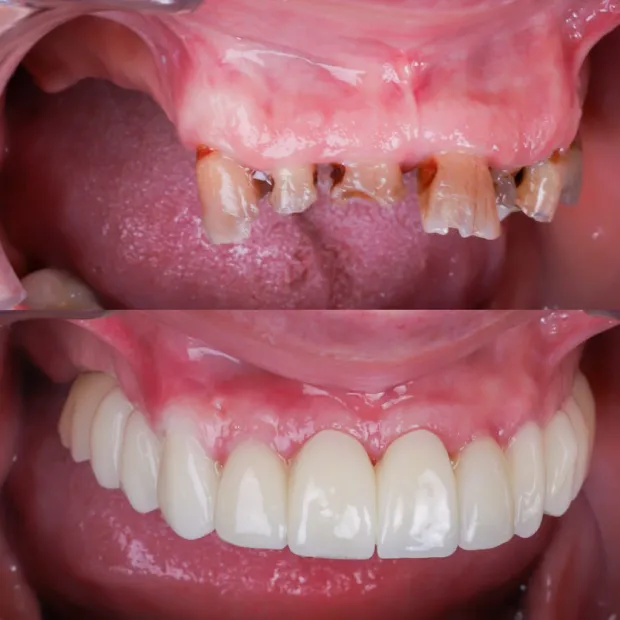 testimonio dentadura fija implantes