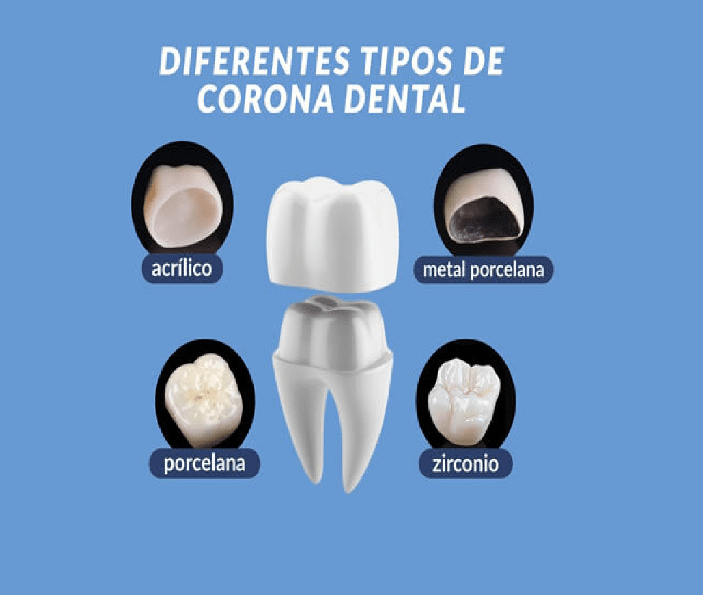 tipos de coronas dentales