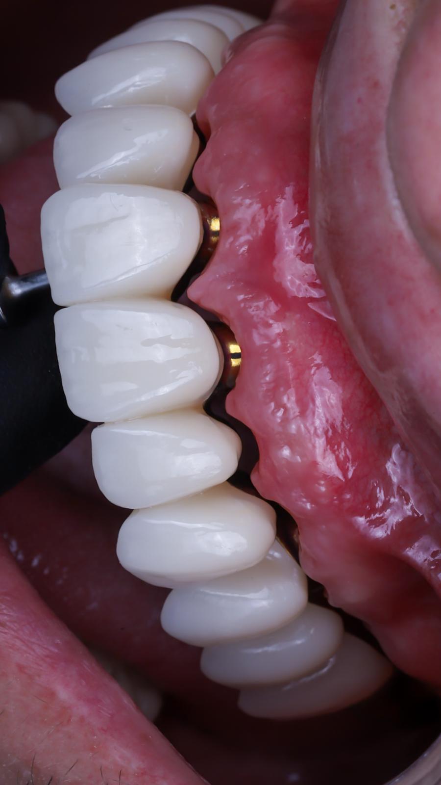 implantes de boca completa en madrid