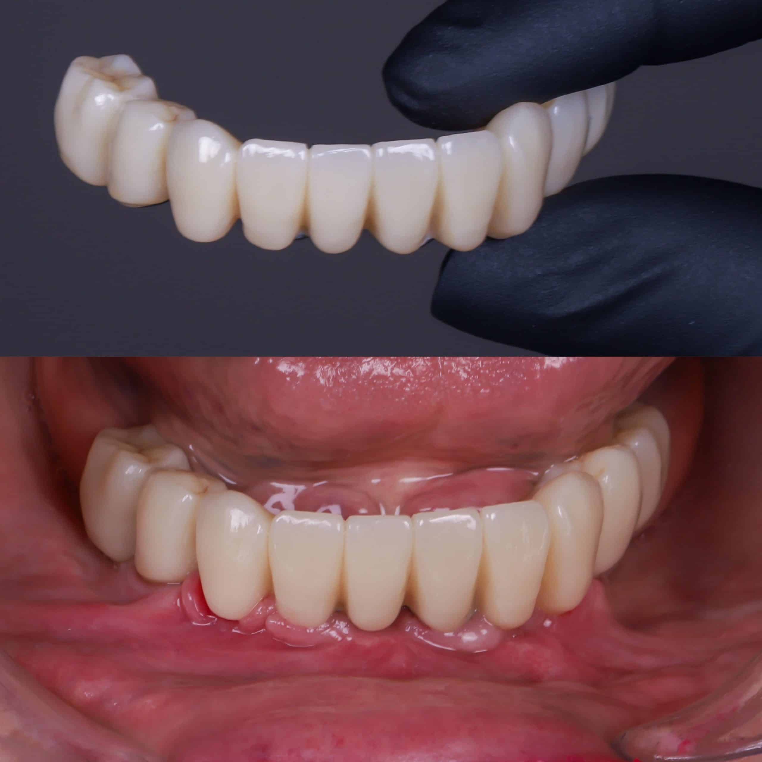 implantes dentales completos