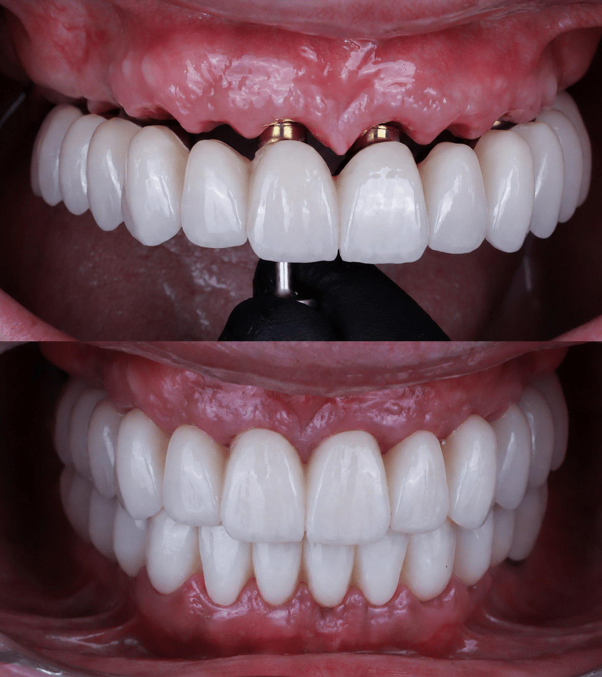 dentadura fija sobre implantes