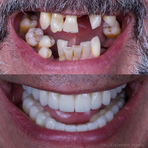 Antes y después de elevacion de seno maxilar.